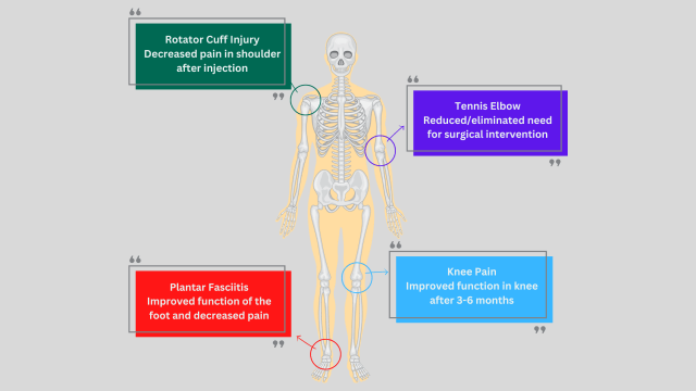 Platelet-Rich Plasma - types of injuries on a skeleton